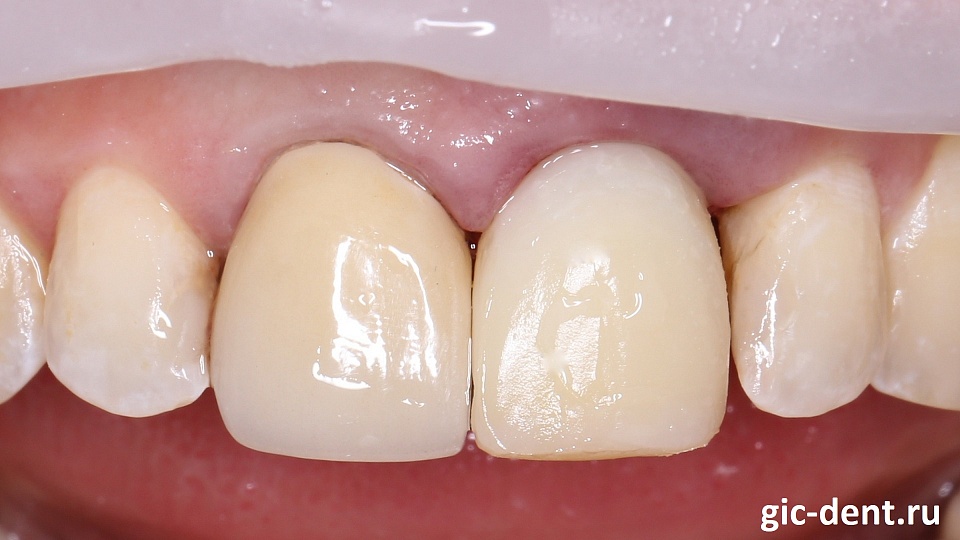 Временное протезирование переднего зуба с одномоментным удалением и имплантацией